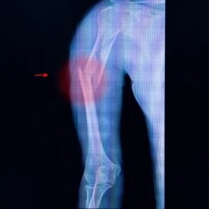 Humerus kırığı Bahçeşehir